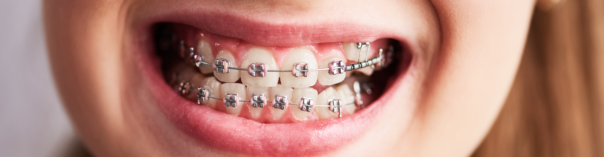 Smiling girl with braces.